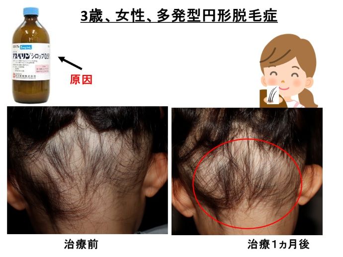 円形脱毛症　病院